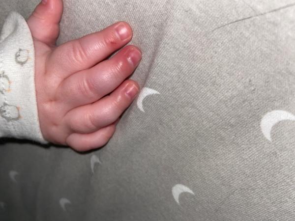 Bild zu Hilfe - Nagelbettentzündung?! - Baby Forum - Allgemeine Themen