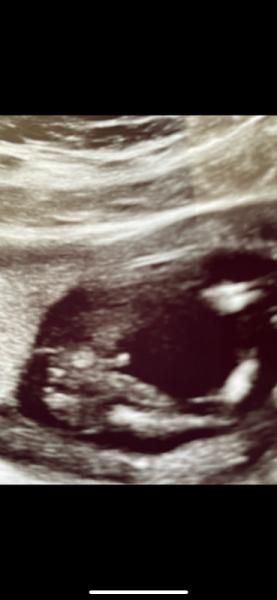 Bild zu Ultraschall Outing - Baby Forum - Allgemeine Themen