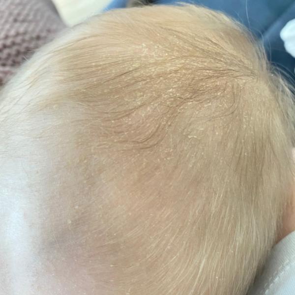 Bild zu Milchschorf oder kopfgneis? - Baby Forum - Allgemeine Themen