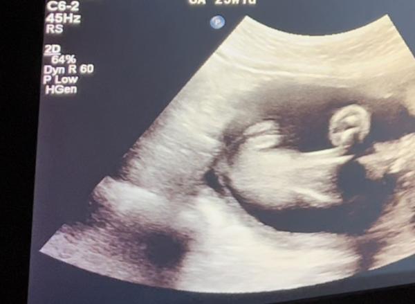 Bild zu Mädchen oder junge - Baby Forum - Allgemeine Themen