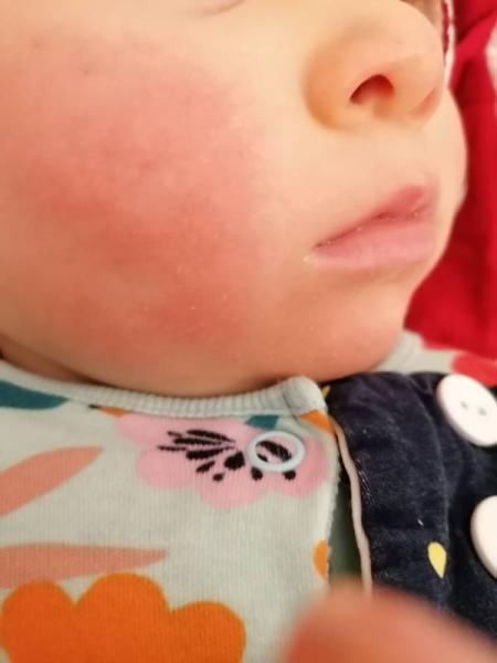 Bild zu Sonnenbrand oder zahnungsbaeckchen? - Baby Forum - Allgemeine Themen