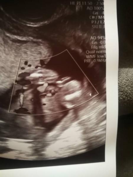 Bild zu Geschlecht 16. SSW - Junge oder Mädchen - Baby Forum - Allgemeine Themen