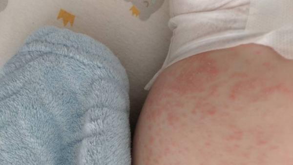 Bild zu Ausschlag - Baby Forum - Allgemeine Themen