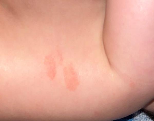 Bild zu Rote Flecken ! Kennt das jemand ? - Baby Forum - Allgemeine Themen