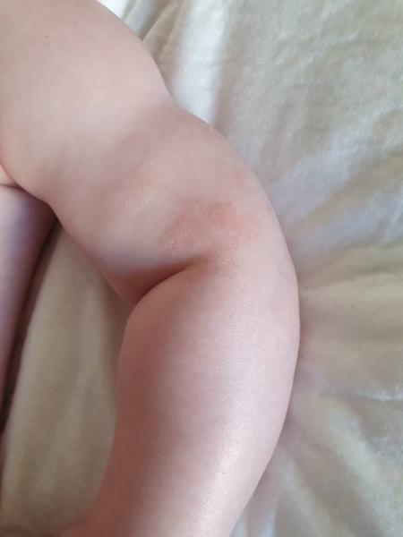 Bild zu Trockene Stellen Baby 15 Wochen alt. - Baby Forum - Allgemeine Themen