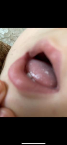 Bild zu Mundsoor Baby - Baby Forum - Allgemeine Themen