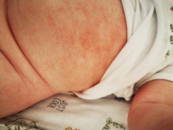 Bild zu Neurodermitis?! - Baby Forum - Allgemeine Themen