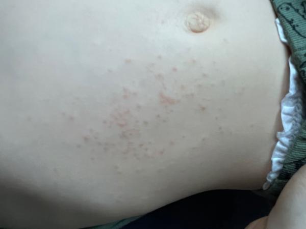 Bild zu Hautauschlag - Baby Forum - Allgemeine Themen
