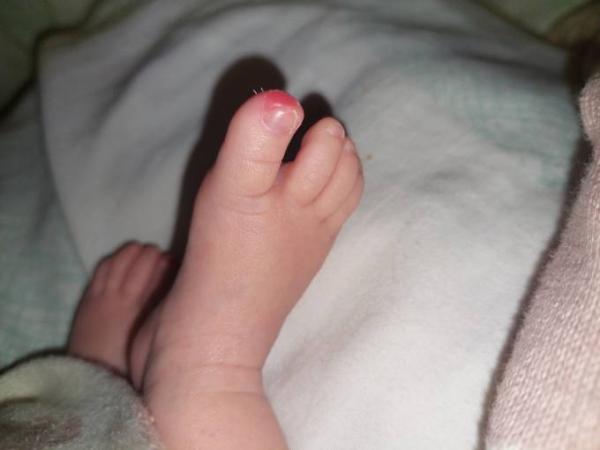 Bild zu Rote große Zehen - Baby Forum - Allgemeine Themen
