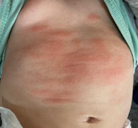 Bild zu Neurodermitis? - Baby Forum - Allgemeine Themen