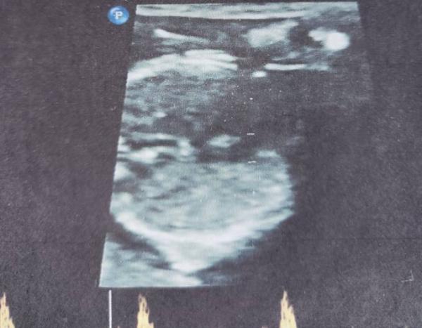 Bild zu Junge oder Mädchen ?14 Ssw - Baby Forum - Allgemeine Themen
