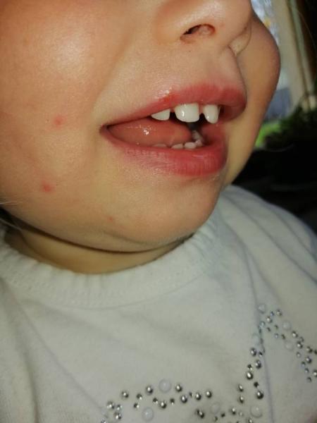 Bild zu Fieberblase? - Baby Forum - Allgemeine Themen