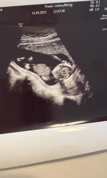 Bild zu Ultraschall - Baby Forum - Allgemeine Themen