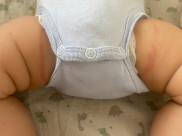 Bild zu Rote Streifen an den Oberschenkel - Baby Forum - Allgemeine Themen