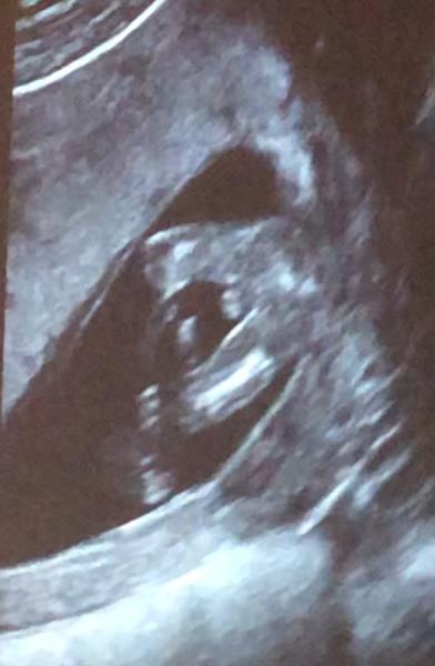 Bild zu Geschlechtsbestimmung SSW 14+1… was meint ihr? - Baby Forum - Allgemeine Themen