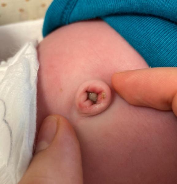 Bild zu Nabelschnur - Baby Forum - Allgemeine Themen