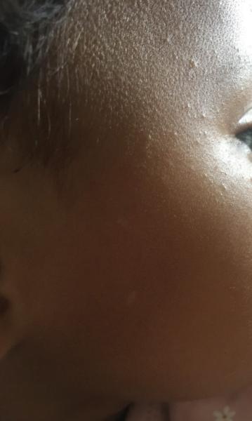 Bild zu Baby 8 Monate Pickel - Baby Forum - Allgemeine Themen