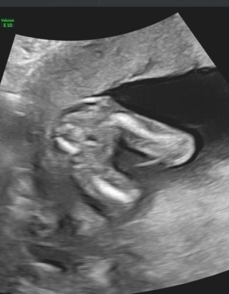 Bild zu Ultraschallfoto - Baby Forum - Allgemeine Themen