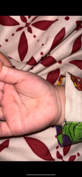 Bild zu Rote flecken - Baby Forum - Allgemeine Themen