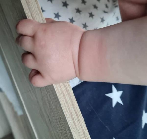 Bild zu Sonnenbrand? - Baby Forum - Allgemeine Themen