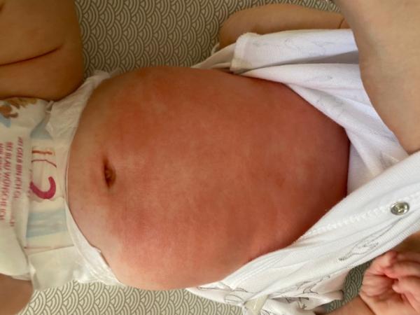 Bild zu Starker Ausschlag - Baby Forum - Allgemeine Themen