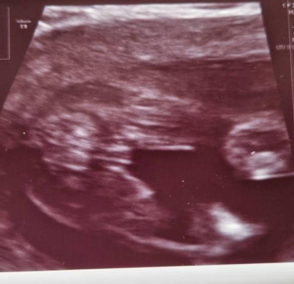 Bild zu Mädchen oder Junge? - Baby Forum - Allgemeine Themen