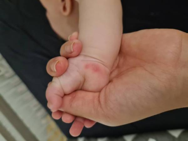 Bild zu Bläschen auf der Hand - Baby Forum - Allgemeine Themen