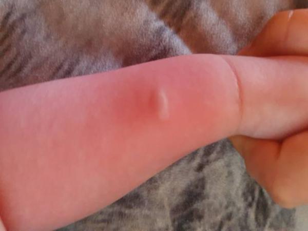 Bild zu Blase oder Pustel - Baby Forum - Allgemeine Themen