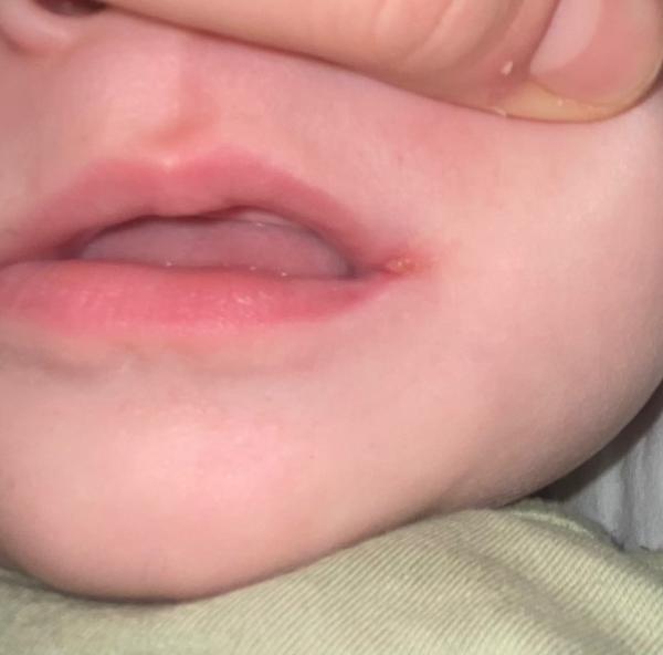 Bild zu Ist das Herpes? đ - Baby Forum - Allgemeine Themen