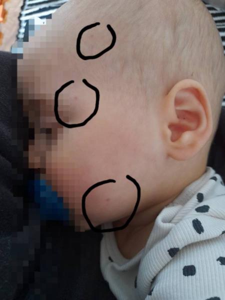 Bild zu Rote Punkte im Gesicht - Baby Forum - Allgemeine Themen