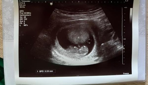 Bild zu Vorder oder Hinterwandplazenta - Baby Forum - Allgemeine Themen