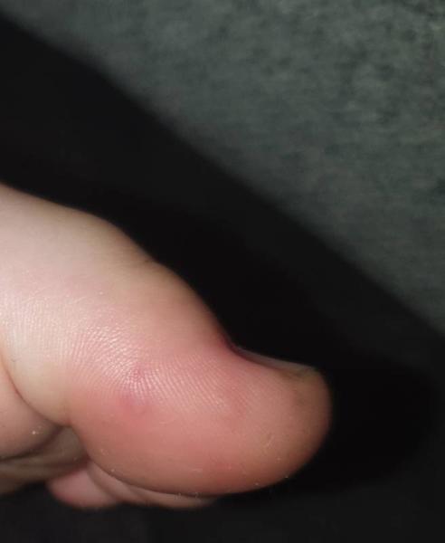 Bild zu Hand-Mund-Fuß? - Baby Forum - Allgemeine Themen