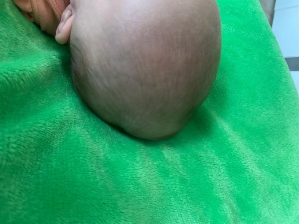 Bild zu Weiche Beule am Hinterköpfen - Baby Forum - Allgemeine Themen