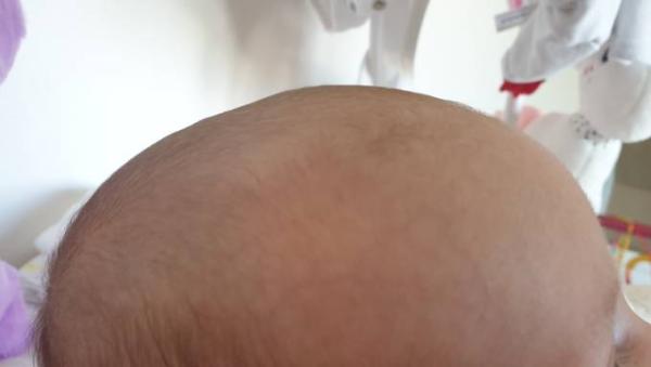 Bild zu Leicht vorgewölbte Fontanelle? - Baby Forum - Allgemeine Themen