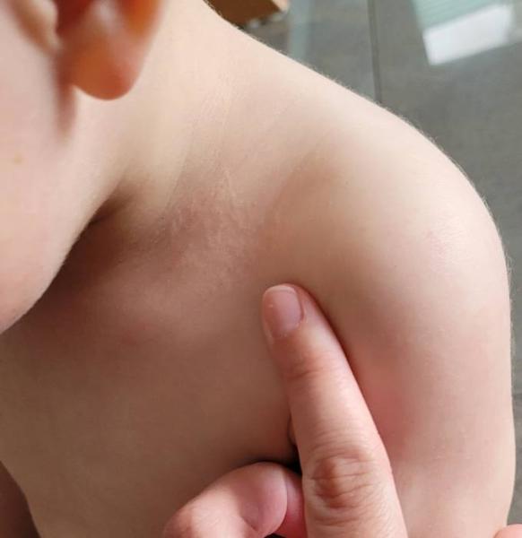 Bild zu Hautveränderung - Baby Forum - Allgemeine Themen