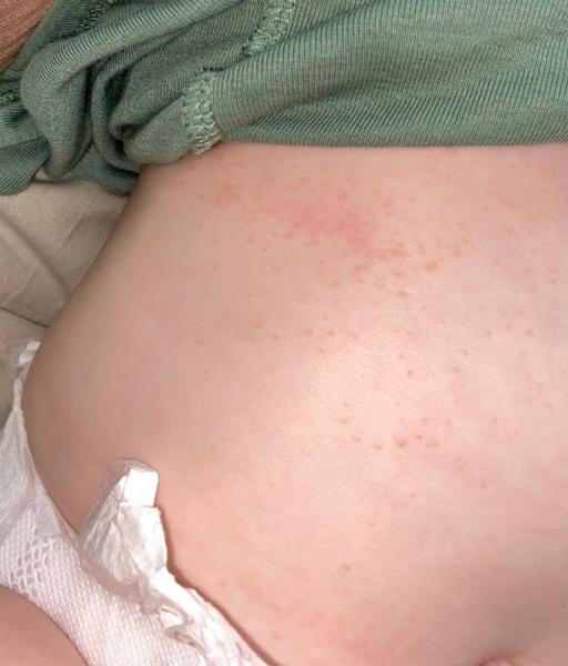 Bild zu Ausschlag am Bauch 🤔 - Baby Forum - Allgemeine Themen