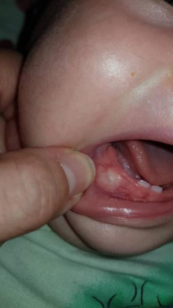 Bild zu Eckzahn oder Zyste??? - Baby Forum - Allgemeine Themen