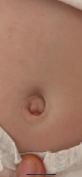 Bild zu Nabelgranulom :( - Baby Forum - Allgemeine Themen