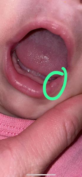 Bild zu Weisses bläschen an der lippe - Baby Forum - Allgemeine Themen