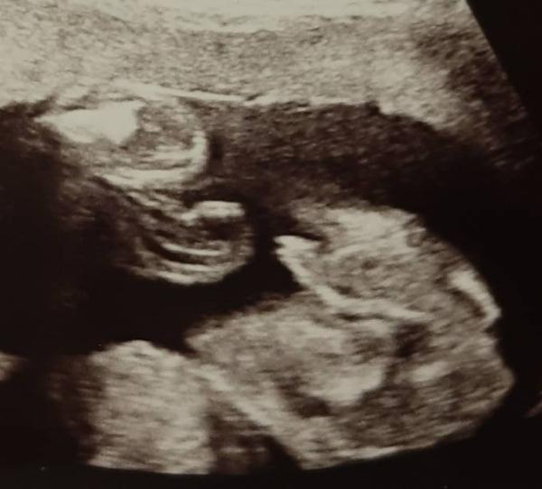Bild zu Junge oder Mädchen - Baby Forum - Allgemeine Themen