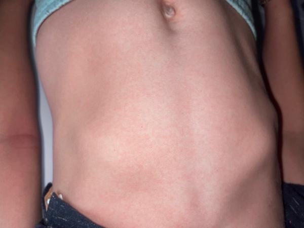 Bild zu Ausschlag bauch !! - Baby Forum - Allgemeine Themen