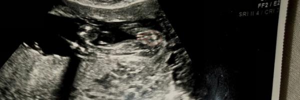 Bild zu Eher Mädchen oder Junge ? 22+2 - Baby Forum - Allgemeine Themen