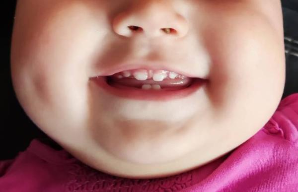 Bild zu Stück Schneidezahn abgebrochen - Baby Forum - Allgemeine Themen
