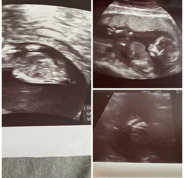 Bild zu Ultraschal/Geschlecht - Baby Forum - Allgemeine Themen