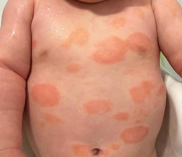 Bild zu Ausschlag oder Hitzeflecken? - Baby Forum - Allgemeine Themen