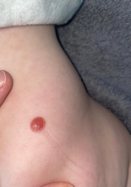 Bild zu Fleck auf Baby Rücken - Baby Forum - Allgemeine Themen
