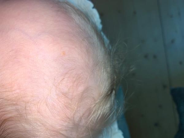 Bild zu Warzen Ähnliches „Gebilde“ am Kopf Baby - Baby Forum - Allgemeine Themen