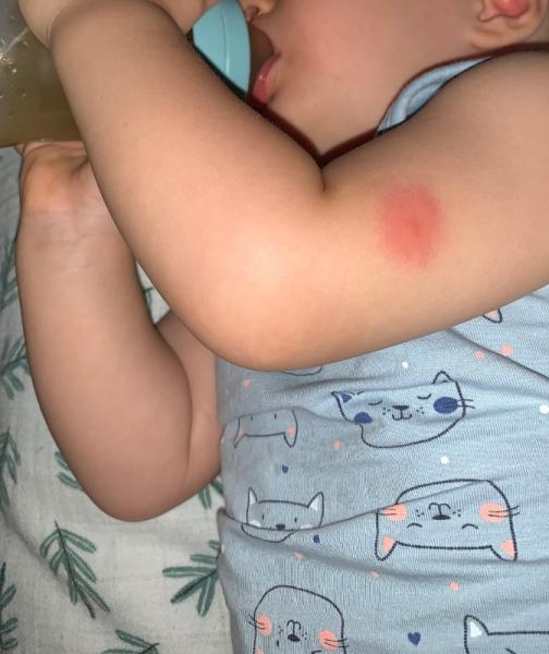 Bild zu MÜCKENSTICH ROT UND RUND! - Baby Forum - Allgemeine Themen