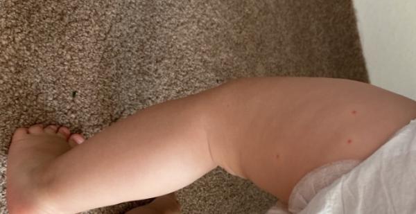 Bild zu Pickelchen an den Oberschenkeln - Baby Forum - Allgemeine Themen