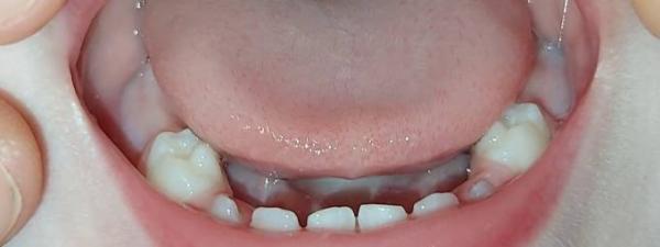 Bild zu Nachtrag zu meinem Post 🦷 - Baby Forum - Allgemeine Themen